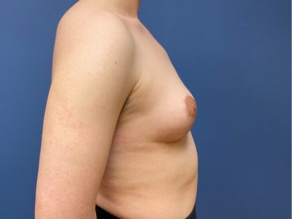Breast Reduction Before & After Patient #9753