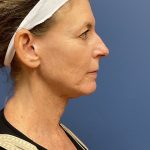 Facelift Before & After Patient #9746