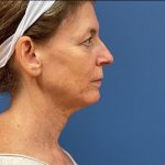 Facelift Before & After Patient #9746