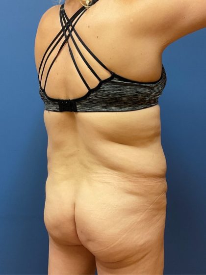 Tummy Tuck Before & After Patient #9764