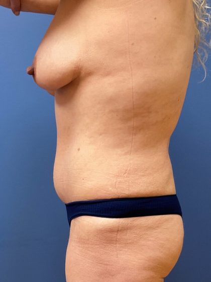 Tummy Tuck Before & After Patient #9764