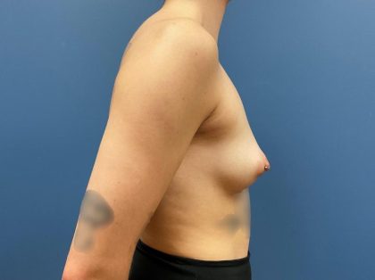Breast Augmentation Before & After Patient #9839