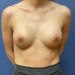 Breast Augmentation Before & After Patient #9830