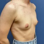 Breast Augmentation Before & After Patient #9830