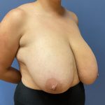 Breast Reduction Before & After Patient #9895