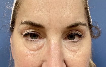 Eyelid Lift Before & After Patient #9954