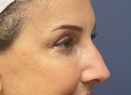 Eyelid Lift Before & After Patient #9954
