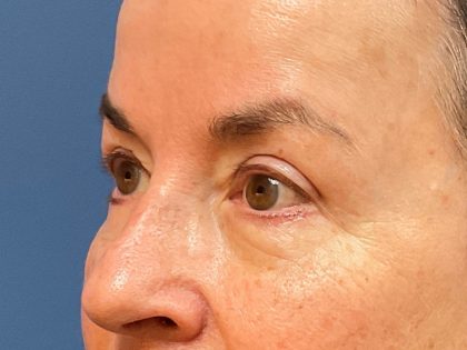 Eyelid Lift Before & After Patient #9959