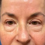Eyelid Lift Before & After Patient #9959
