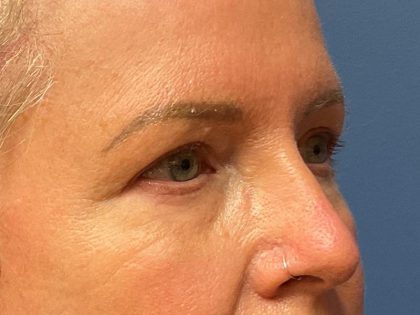 Eyelid Lift Before & After Patient #9935