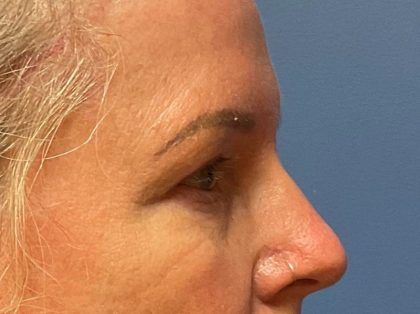 Eyelid Lift Before & After Patient #9935
