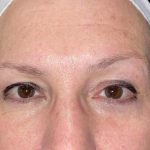 Eyelid Lift Before & After Patient #10007