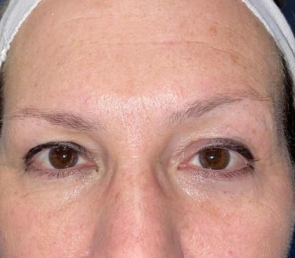 Eyelid Lift Before & After Patient #10007